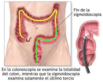 COLITIS ULCERATIVA, PUEDE AFECTAR A CUALQUIER GRUPO DE EDAD COLITIS ULCERATIVA, PUEDE AFECTAR A CUALQUIER GRUPO DE EDAD