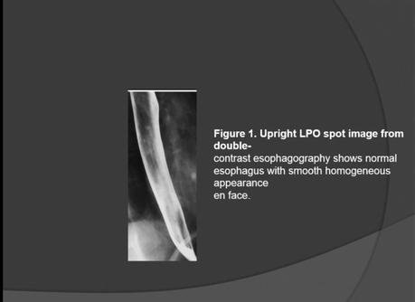 Presencia de hernia hiatal  o reflujo  Gastroesofagico