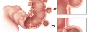 Diverticulosis, diverticulitis, dieta y qué más hacer con respecto a ellos