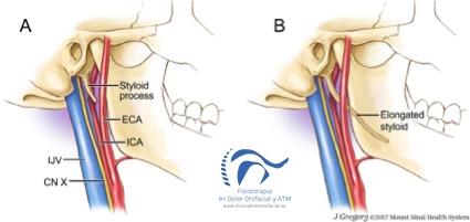 Síndrome de eagle. ¿qué es? Principales características, tratamiento y manejo de este síndrome sindrome de eagle