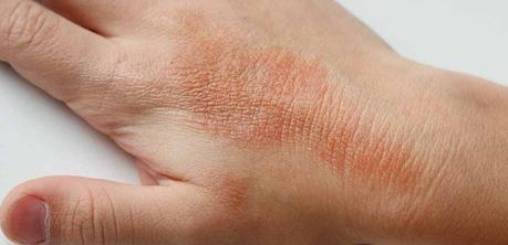 Síntomas del eccema