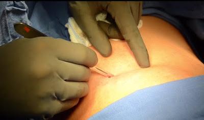 ESTÁ ISSEMYM A LA VANGUARDIA NACIONAL EN DIAGNÓSTICOS Y CIRUGÍAS TORÁCICAS ESTÁ ISSEMYM A LA VANGUARDIA NACIONAL EN DIAGNÓSTICOS Y CIRUGÍAS TORÁCICAS