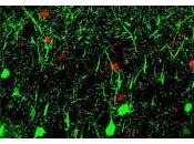 Encuentran forma sencilla Detectar Enfermedades Neurológicas