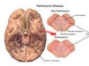 Droga detiene Progresión Enfermedad Parkinson