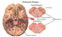 Droga detiene la Progresión de la Enfermedad de Parkinson
