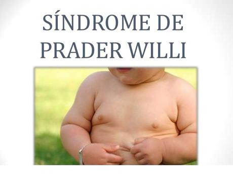 Síndrome de Prader-Willi