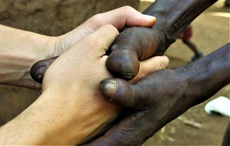 Combatimos al peor enemigo de la lepra: el hombre