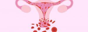 Mucosidad cervical y lo que significa Posibles complicaciones después de la ablación endometrial