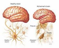 El Uso de Antivirales puede Mejorar la Enfermedad de Alzheimer