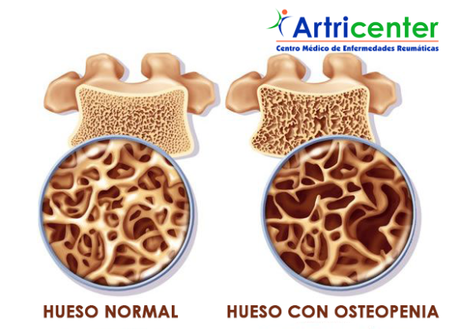 Artricenter: La artritis, los síntomas y los efectos que se presentan en otros órganos.