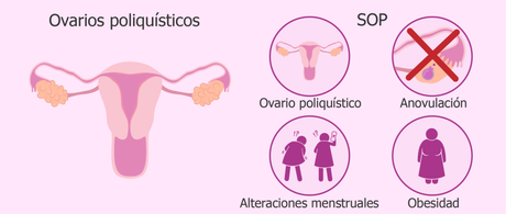 Síndrome de Ovario Poliquístico