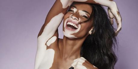 Vitíligo Síntomas del vitíligo