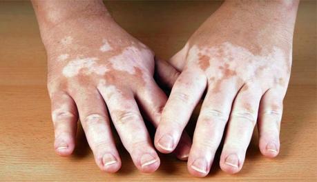 Vitíligo Tratamiento del vitíligo