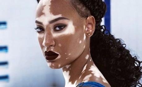 Vitíligo Causas del vitíligo