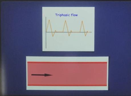 Como es el comportamiento de un Espectro Trifasico en el Doppler Arterial
