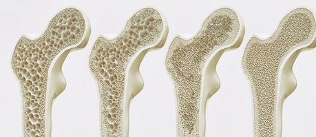 Osteoporosis