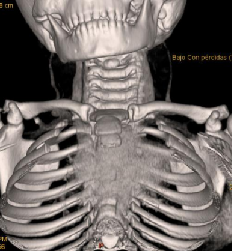 Caso Clínico: Niño que presenta tortícolis de 3 días de evolución