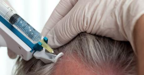 Mesoterapia Mesoterapia para el cabello