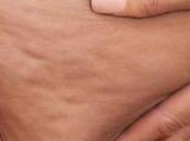Mesoterapia