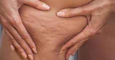 Mesoterapia Celulitis