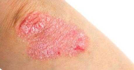 Psoriasis