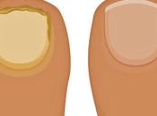 remedios para eliminar Onicomicosis (hongos uñas pie)