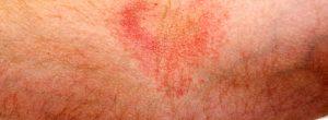 Intertrigo: ¿Qué puede hacer con la erupción cutánea que afecta los pliegues de la piel?