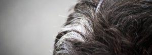 Poliosis: parches de cabello blancos localizados