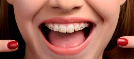 Problemas más frecuentes en un tratamiento de ortodoncia con brackets