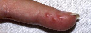 Infecciones rojas y ardientes en los dedos: lo que puede ser y lo que puede hacer con respecto a ellas