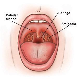 Qué es una faringitis
