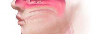 Pólipos nasales y dolor nasal