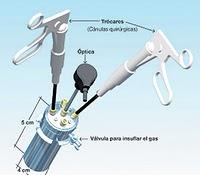 El ombligo, nueva 'puerta' para sacar un riñón