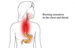 Los personas con reflujo esofagico deben tener un tratamiento individualizado