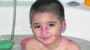 Qué es la piel de mariposa