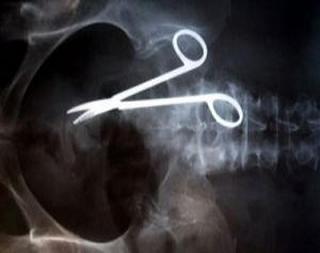 Mujer vive dos años con  tijeras en su vientre