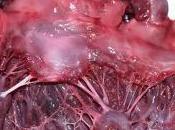 Cirugia Percutanea Valvula Mitral