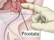 Disminuyen muertes cáncer próstata gracias diagnóstico precoz avances terapéuticos