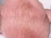 Aumentan casos plagiocefalia