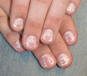 Aparición de manchas blancas