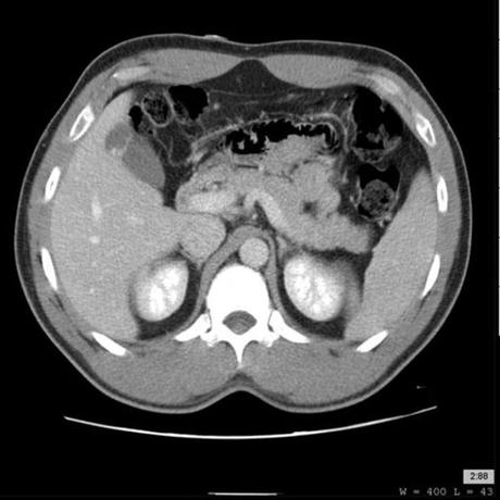 Vesícula biliar en gorro frigio Vesícula biliar en gorro frigio