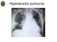Nuevo Tratamiento para la Hipertensión Arterial Pulmonar