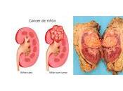 Revelan Origen Preciso Células Cancerosas Renales