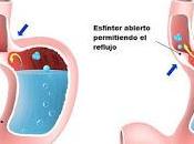¿Que Factores Provocan Reflujo Ácido?
