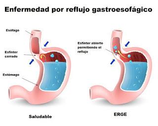 Reflujo, enfermedad del reflujo acido, que es el reflujo acido, acidez cronica del estomago, factores que provocan el reflujo, acidez, 