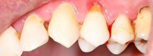 ¿Son los dientes flojos una señal de una enfermedad de las encías?