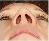 Porqué los Pacientes con Rinosinusitis desarrollan Pólipos Nasales