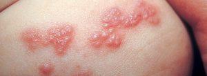 Infección por herpes simple: una breve descripción