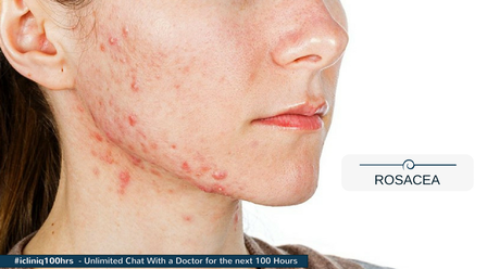 Piel con Rosácea, cómo reconocerla Piel con Rosácea, cómo reconocerla