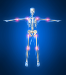 5 señales para reconocer a la osteoartritis articulaciones